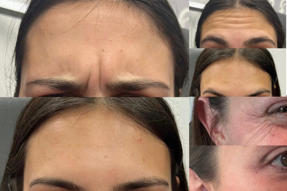 Deeva Lab Philadelphia Botox and Filler Before and After 2