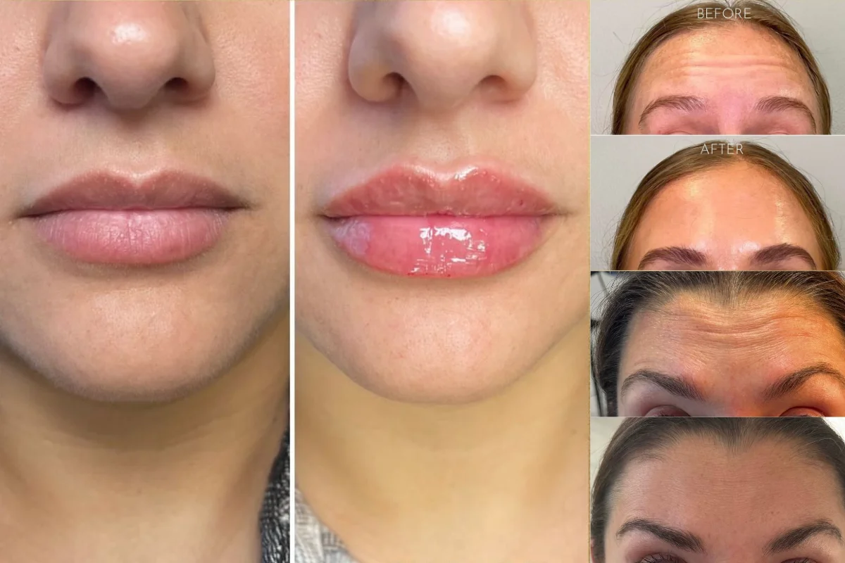 Deeva Lab Philadelphia Botox and Filler Before and After 3